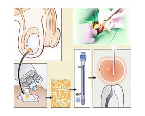 婴儿支气管肺炎它的发病原因是什么*代怀机构