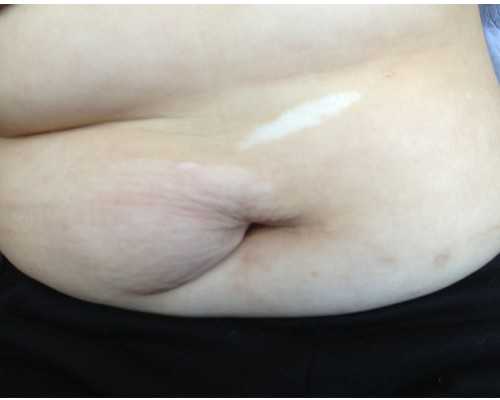 疤痕妊娠可以继续妊娠吗*供卵试管服务