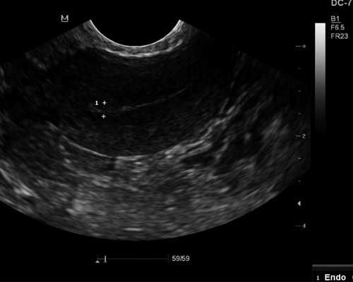供卵助孕成功率_高龄供卵,【北京供卵试管成功率高不高供卵要多少钱】终于成